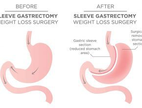 gastric sleeve Gastric Sleeve