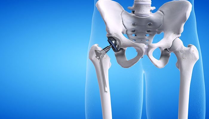 hip replacement