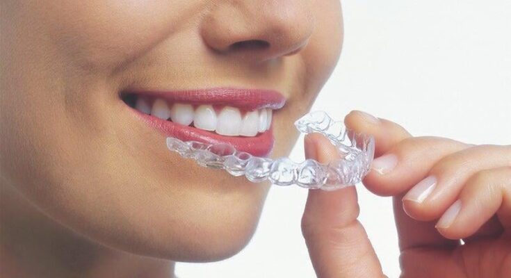 Invisalign in Noida