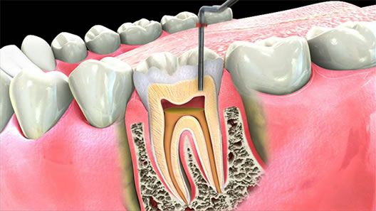 Endodontic Therapy