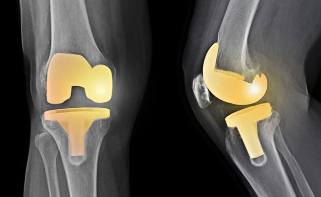Arthroplasty Arthroplasty