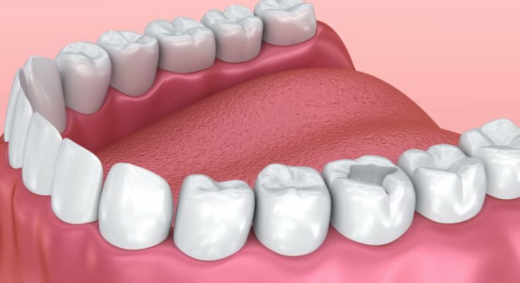 Dental Fillings Dental Fillings