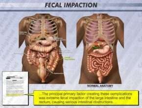 Fecal Impaction