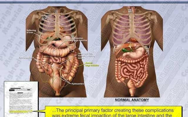 Fecal Impaction