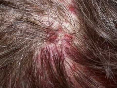 1a139ba84fa978d6836ce478ba7d9d46 pimples on scalp itchy scalp