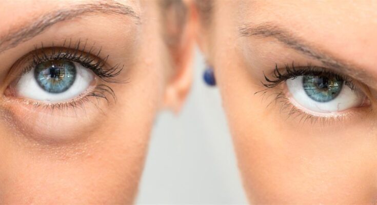How to Find the Best Eyelid Surgery Near Me: Tips for Locating a Qualified Surgeon